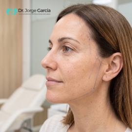 Hilos de Tracción: El Efecto Tensor sin Cirugía para Recuperar el Óvalo Facial en Valladolid y Salam